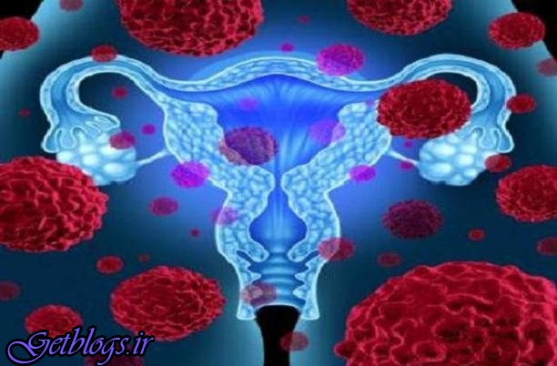 زنان باید در مورد سرطان تخمدان بدانند